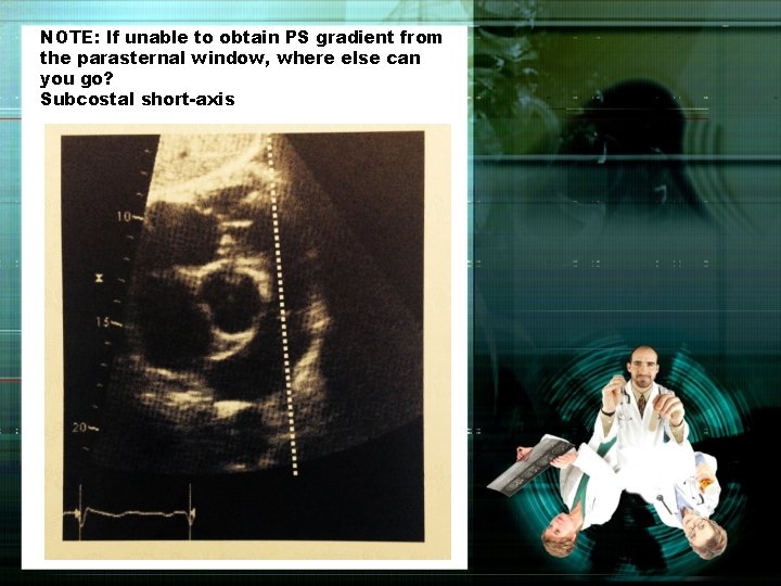 NOTE: If unable to obtain PS gradient from the parasternal window, where else can