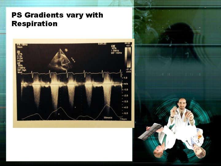 PS Gradients vary with Respiration 