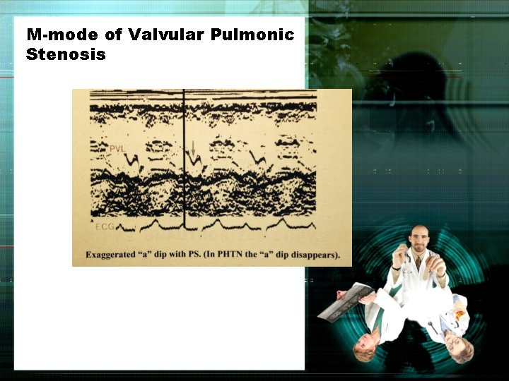 M-mode of Valvular Pulmonic Stenosis 