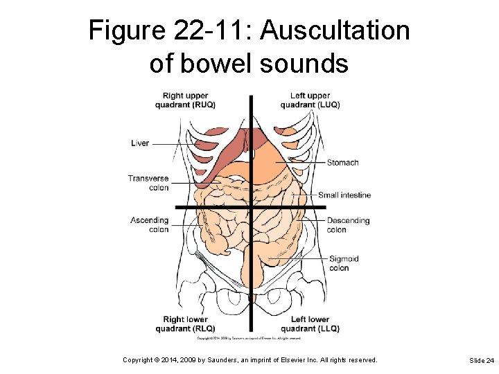 Figure 22 -11: Auscultation of bowel sounds Copyright © 2014, 2009 by Saunders, an