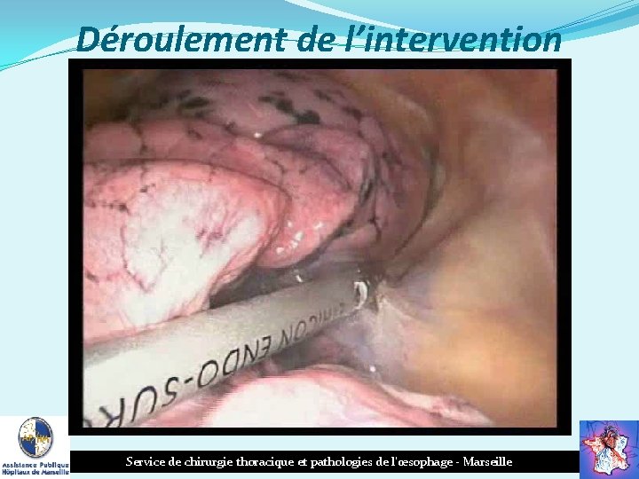 Déroulement de l’intervention Service de chirurgie thoracique et pathologies de l’œsophage - Marseille 