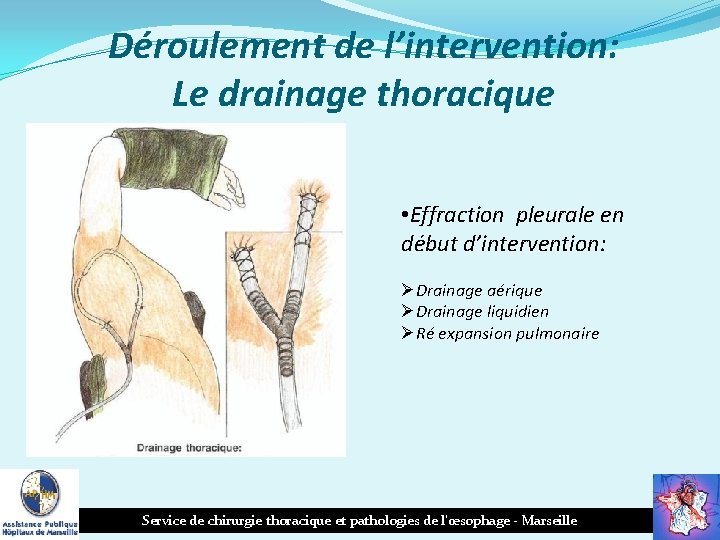 Déroulement de l’intervention: Le drainage thoracique • Effraction pleurale en début d’intervention: ØDrainage aérique