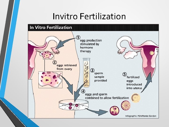 Invitro Fertilization 