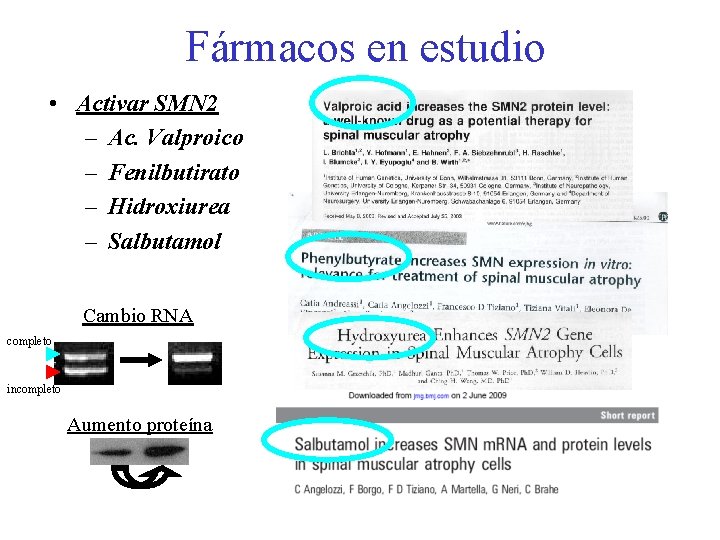 Fármacos en estudio • Activar SMN 2 – Ac. Valproico – Fenilbutirato – Hidroxiurea