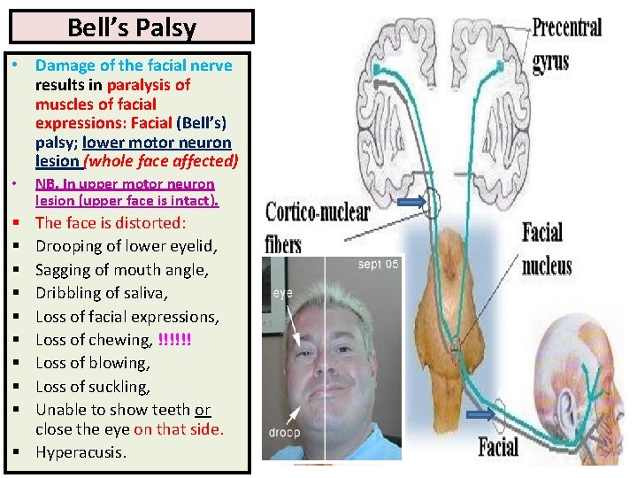 Bell’s Palsy • Damage of the facial nerve results in paralysis of muscles of