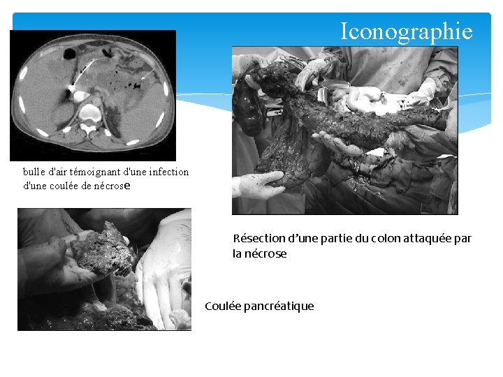 Iconographie bulle d'air témoignant d'une infection d'une coulée de nécrose Résection d’une partie du