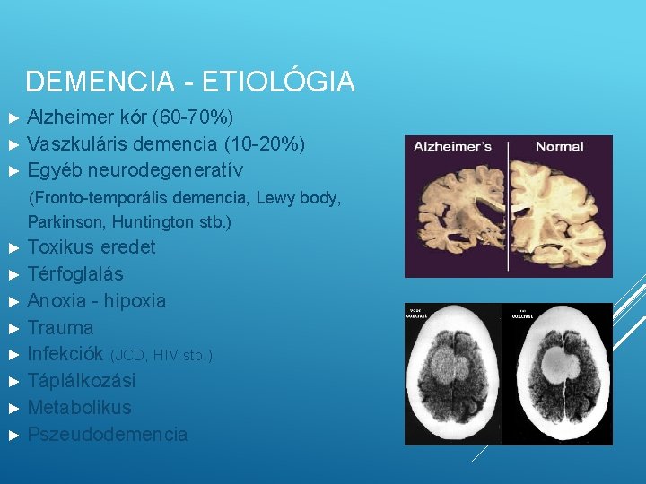 DEMENCIA - ETIOLÓGIA ► Alzheimer kór (60 -70%) ► Vaszkuláris demencia (10 -20%) ►