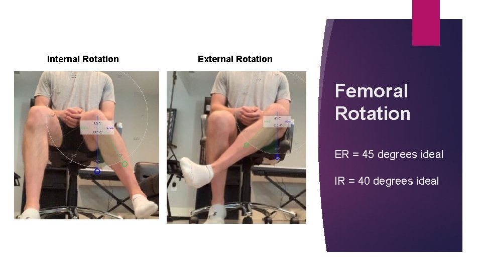 Internal Rotation External Rotation Femoral Rotation ER = 45 degrees ideal IR = 40