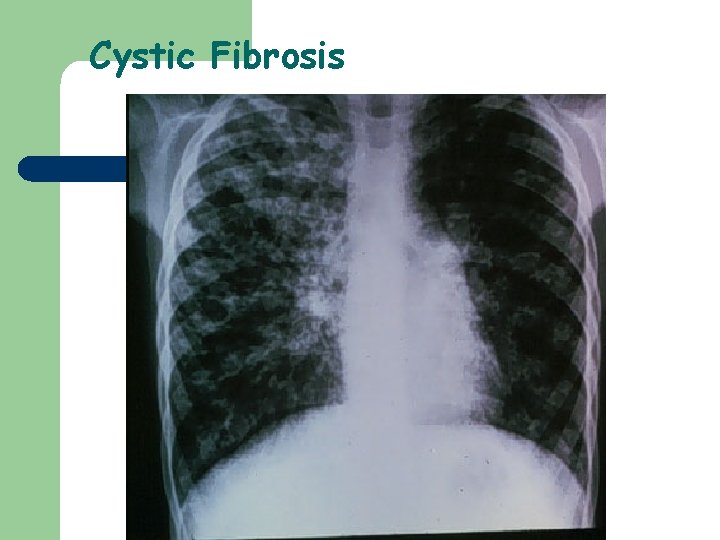 Cystic Fibrosis 