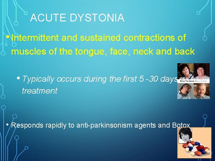 ACUTE DYSTONIA • Intermittent and sustained contractions of muscles of the tongue, face, neck