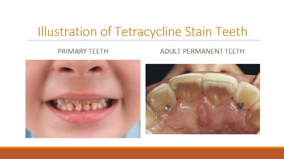 Illustration of Tetracycline Stain Teeth PRIMARY TEETH ADULT PERMANENT TEETH 