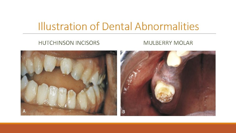 Illustration of Dental Abnormalities HUTCHINSON INCISORS MULBERRY MOLAR 