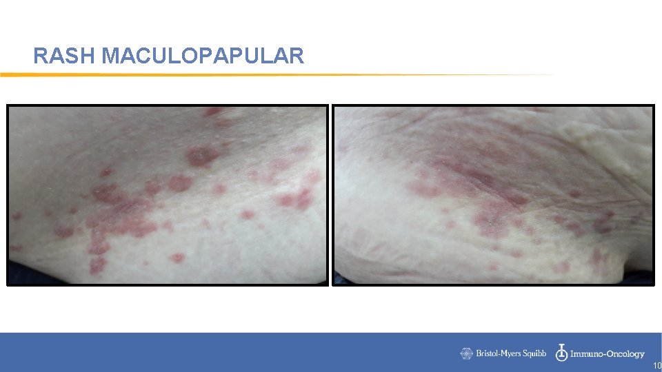 RASH MACULOPAPULAR 10 