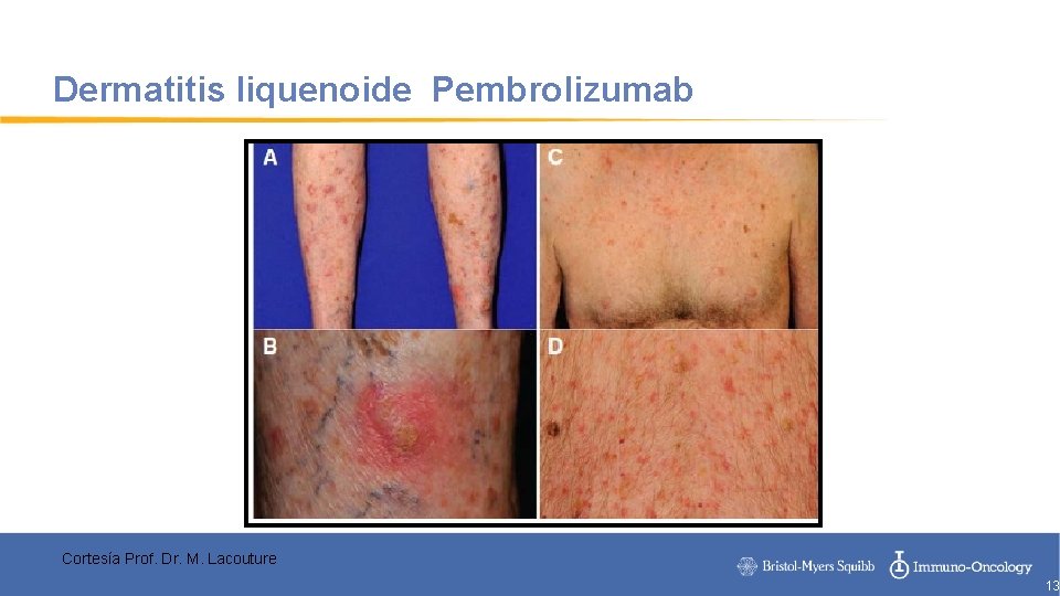 Dermatitis liquenoide Pembrolizumab Cortesía Prof. Dr. M. Lacouture 13 