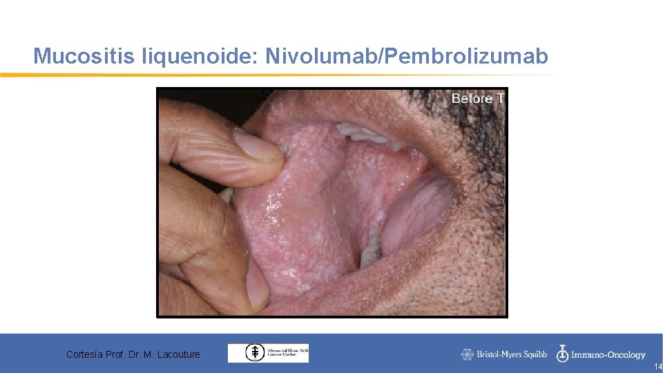 Mucositis liquenoide: Nivolumab/Pembrolizumab Cortesía Prof. Dr. M. Lacouture 14 