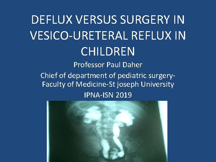 DEFLUX VERSUS SURGERY IN VESICO-URETERAL REFLUX IN CHILDREN Professor Paul Daher Chief of department