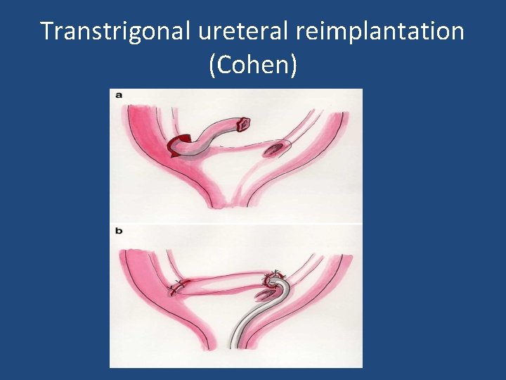 Transtrigonal ureteral reimplantation (Cohen) 