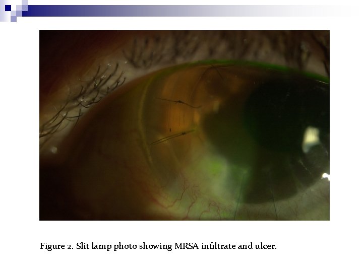 Figure 2. Slit lamp photo showing MRSA infiltrate and ulcer. 