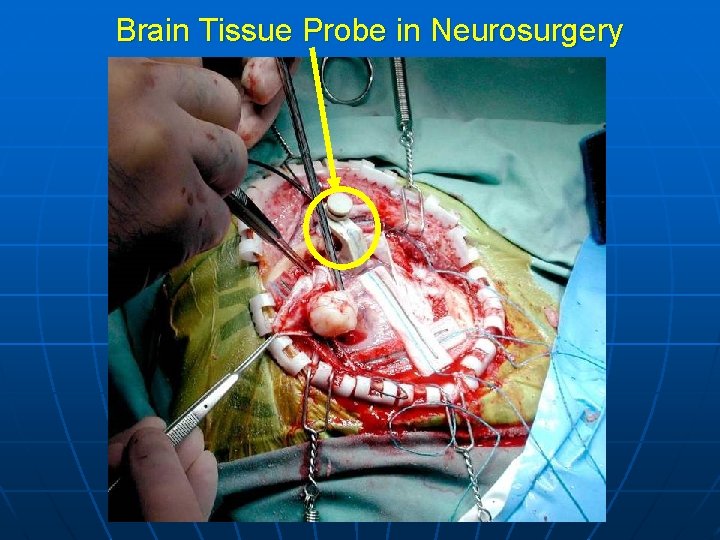 Brain Tissue Probe in Neurosurgery 
