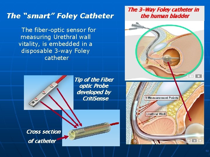 The “smart” Foley Catheter The 3 -Way Foley catheter in the human bladder The