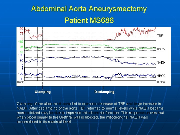 Abdominal Aorta Aneurysmectomy Patient MS 686 10 min Clamping Declamping Clamping of the abdominal