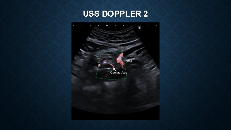 USS DOPPLER 2 