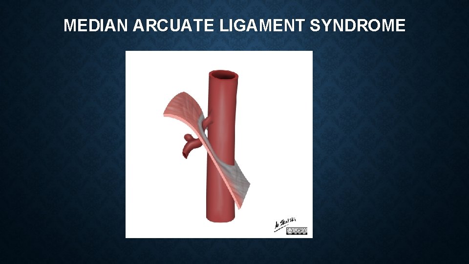 MEDIAN ARCUATE LIGAMENT SYNDROME 