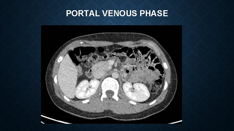 PORTAL VENOUS PHASE 