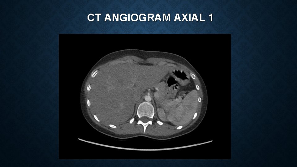 CT ANGIOGRAM AXIAL 1 