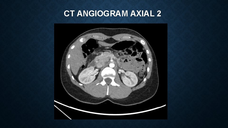 CT ANGIOGRAM AXIAL 2 