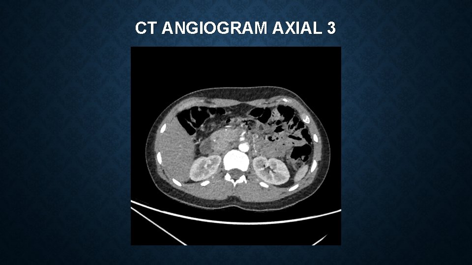 CT ANGIOGRAM AXIAL 3 