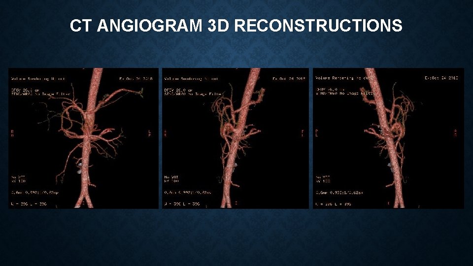 CT ANGIOGRAM 3 D RECONSTRUCTIONS 
