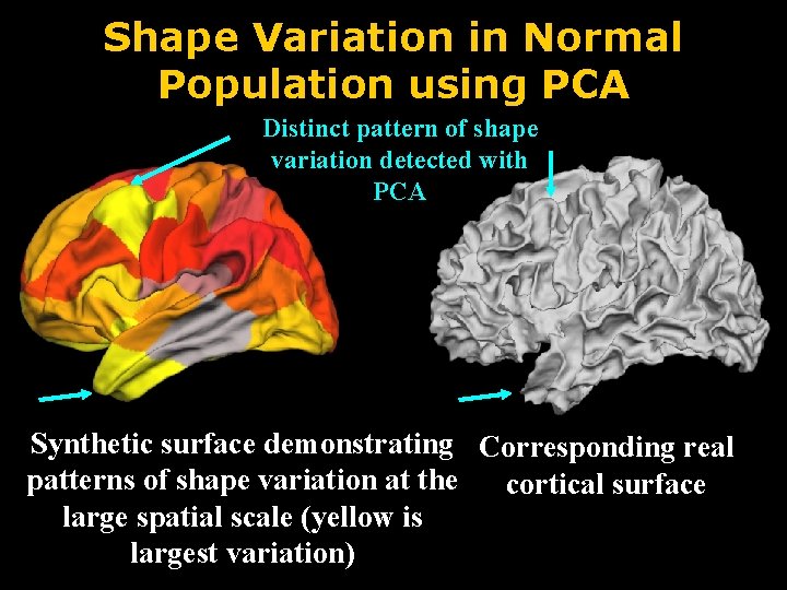 Shape Variation in Normal Population using PCA Distinct pattern of shape variation detected with