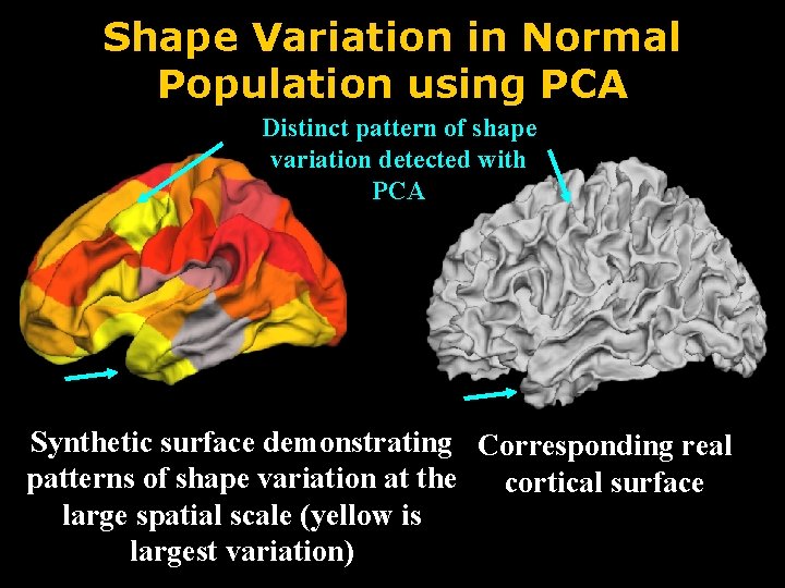 Shape Variation in Normal Population using PCA Distinct pattern of shape variation detected with