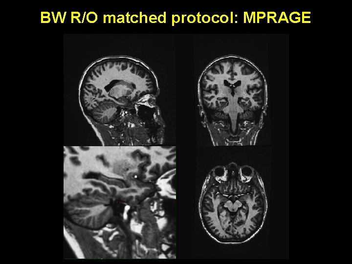 BW R/O matched protocol: MPRAGE 