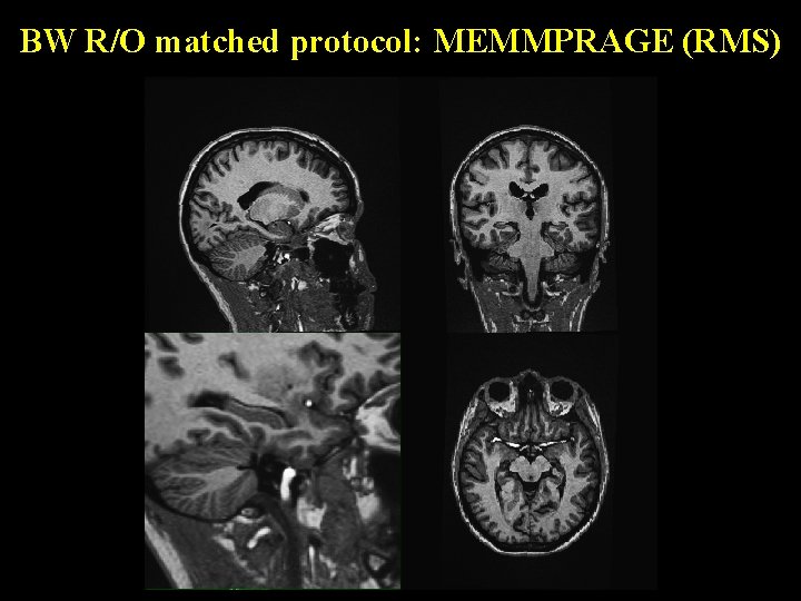 BW R/O matched protocol: MEMMPRAGE (RMS) 