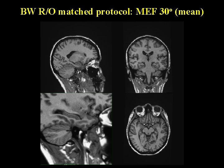 BW R/O matched protocol: MEF 30 o (mean) 