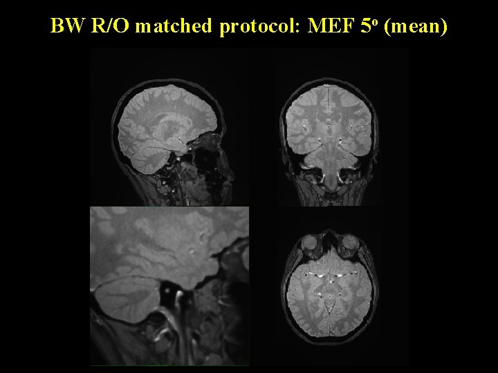 BW R/O matched protocol: MEF 5 o (mean) 