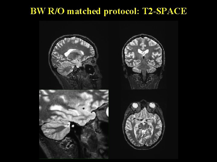 BW R/O matched protocol: T 2 -SPACE 