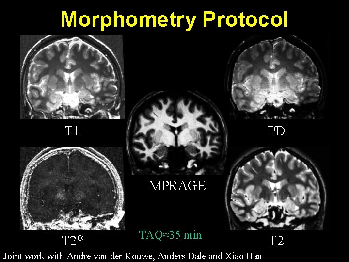 Morphometry Protocol PD T 1 MPRAGE T 2* TAQ≈35 min Joint work with Andre