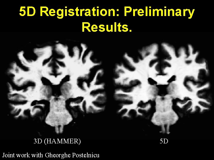 5 D Registration: Preliminary Results. 3 D (HAMMER) Joint work with Gheorghe Postelnicu 5