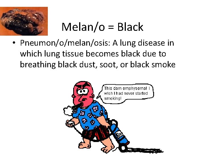 Melan/o = Black • Pneumon/o/melan/osis: A lung disease in which lung tissue becomes black