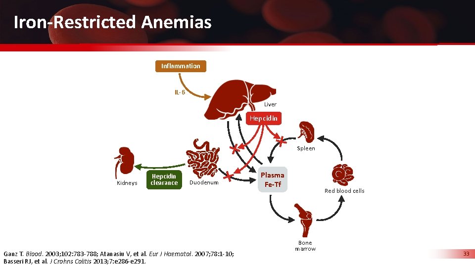 Iron-Restricted Anemias Inflammation IL-6 Liver Hepcidin Spleen Kidneys Hepcidin clearance Duodenum Ganz T. Blood.
