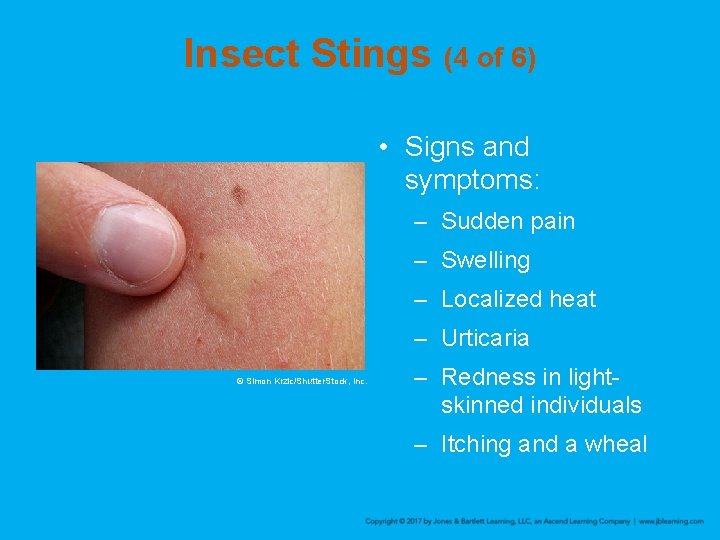Insect Stings (4 of 6) • Signs and symptoms: – Sudden pain – Swelling