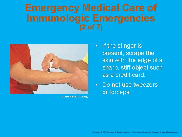 Emergency Medical Care of Immunologic Emergencies (2 of 7) • If the stinger is