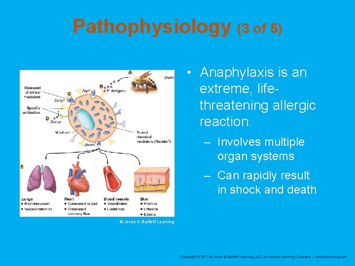 Pathophysiology (3 of 5) • Anaphylaxis is an extreme, lifethreatening allergic reaction. – Involves