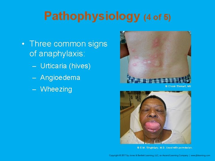 Pathophysiology (4 of 5) • Three common signs of anaphylaxis: – Urticaria (hives) –