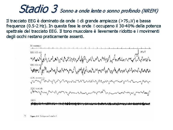 Stadio 3 Sonno a onde lente o sonno profondo (NREM) Il tracciato EEG è