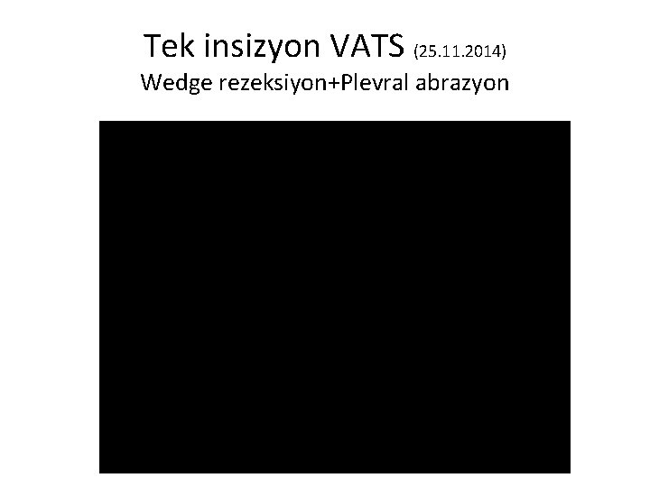 Tek insizyon VATS (25. 11. 2014) Wedge rezeksiyon+Plevral abrazyon 