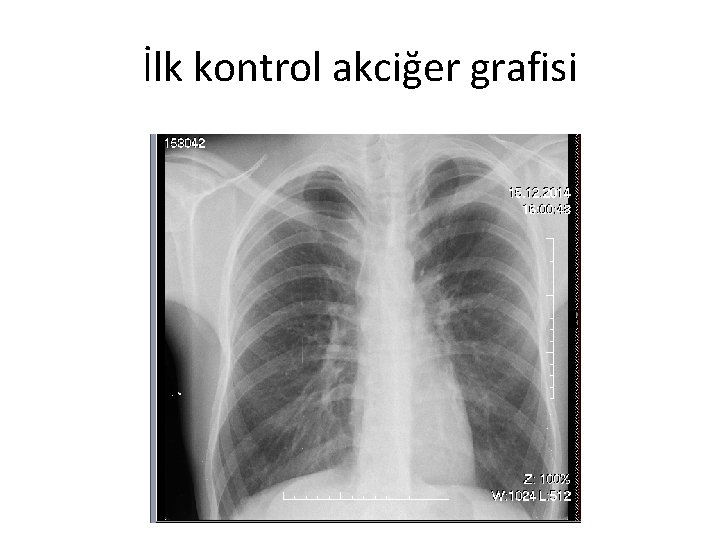 İlk kontrol akciğer grafisi 